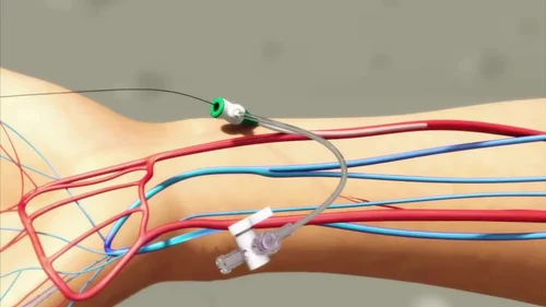 terumo-tiger-catheter-rh-5tig110m-500x500 (1)