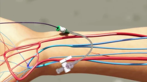 terumo-tiger-catheter-rh-5tig110m-500x500 (2)